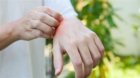 Cockroach Bite Treatment Guide: How to Spot, Treat, and Prevent.